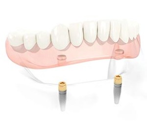 Digital Dentures Implant