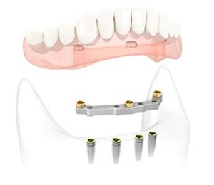 Digital Dentures Process