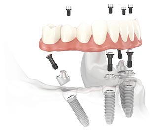 Digital Denture Implant Process
