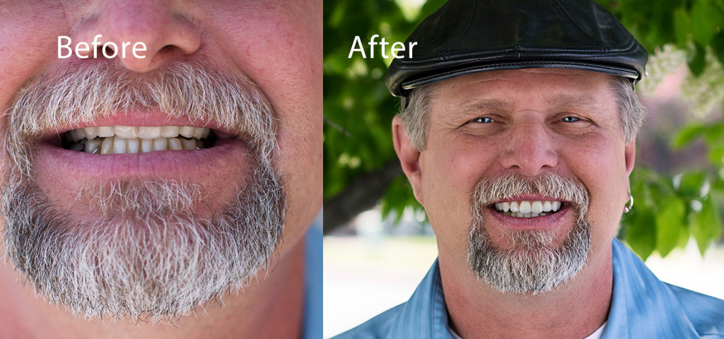 Before and After Digital Dentures