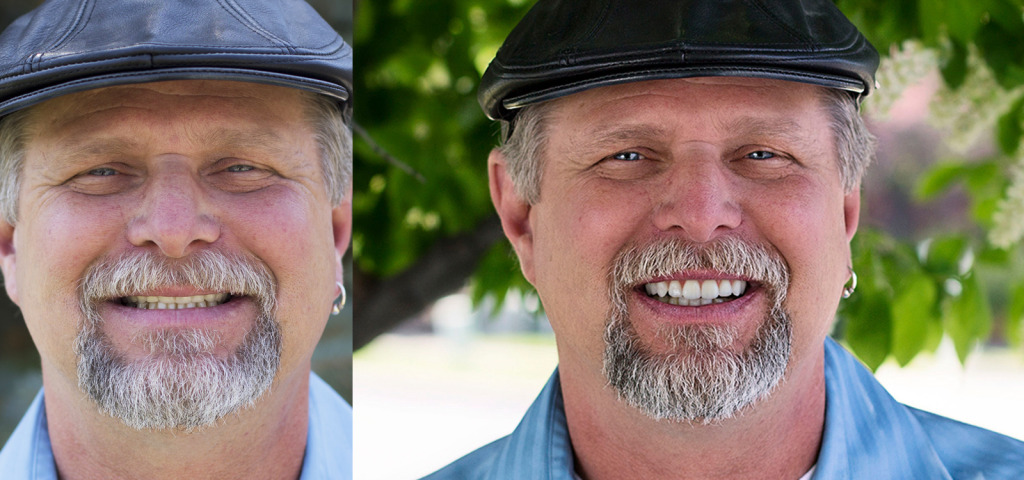 Digital Dentures Patient before and after smile